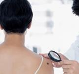 Llega el verano y aumenta la exposición al sol, ¿qué tipo de lunares hay que vigilar?