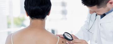 Llega el verano y aumenta la exposición al sol, ¿qué tipo de lunares hay que vigilar?