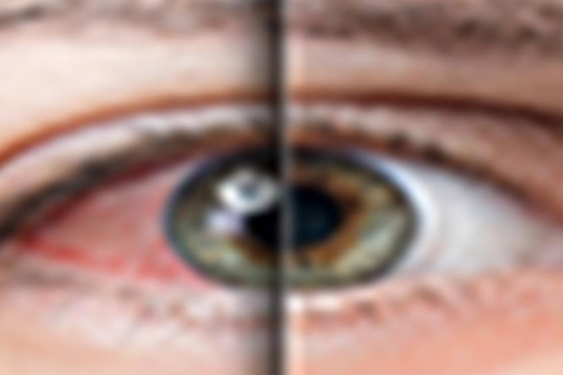 Ojo seco: por qué tanta gente sufre este problema