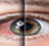 Ojo seco: por qué tanta gente sufre este problema