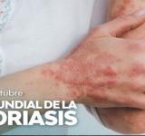 Día Mundial de la Psoriasis