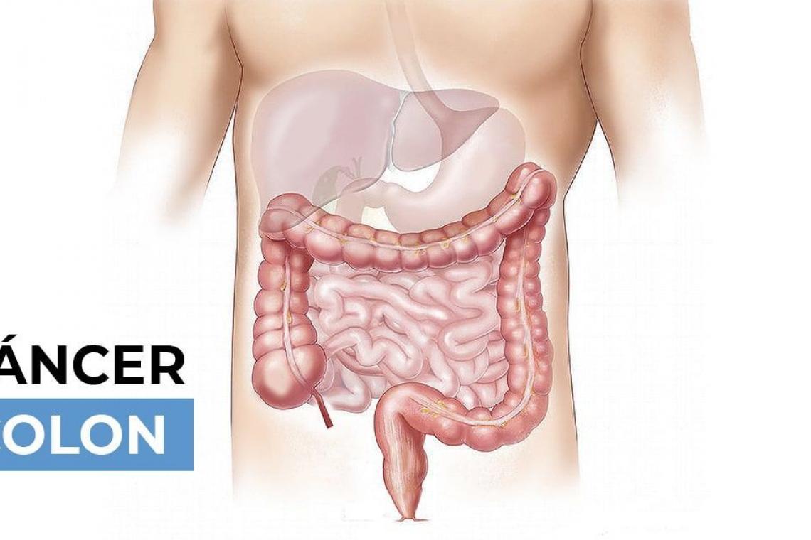 Salud avanza en la implementación de test para la prevención del cáncer de colon