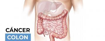 Salud avanza en la implementación de test para la prevención del cáncer de colon