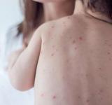 La provincia informó que argentina está en alerta por casos de sarampión