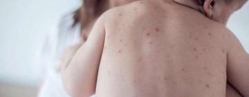 La provincia informó que argentina está en alerta por casos de sarampión