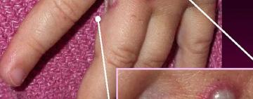 Viruela del mono: ¿puede convertirse en pandemia? (y otras 3 incógnitas sobre esta enfermedad)