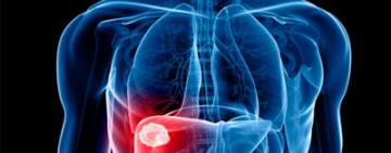 HEPATITIS C: EN LA ACTUALIDAD SOLO UN BAJO NÚMERO DE PACIENTES ES DIAGNOSTICADO EN AMÉRICA LATINA