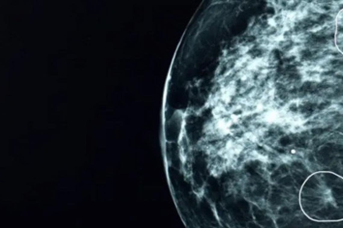 La herramienta de inteligencia artificial que detecta tumores de cáncer que no pueden ver los médicos