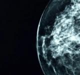 La herramienta de inteligencia artificial que detecta tumores de cáncer que no pueden ver los médicos