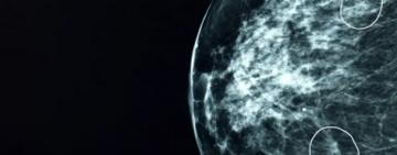 La herramienta de inteligencia artificial que detecta tumores de cáncer que no pueden ver los médicos