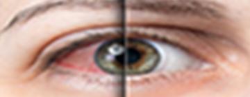 Ojo seco: por qué tanta gente sufre este problema